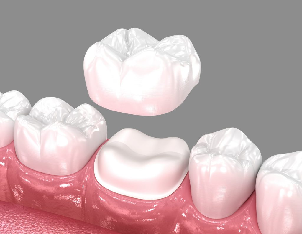 Do You Really Need a Dental Crown? Signs a Tooth Can’t Be Saved with a Filling
